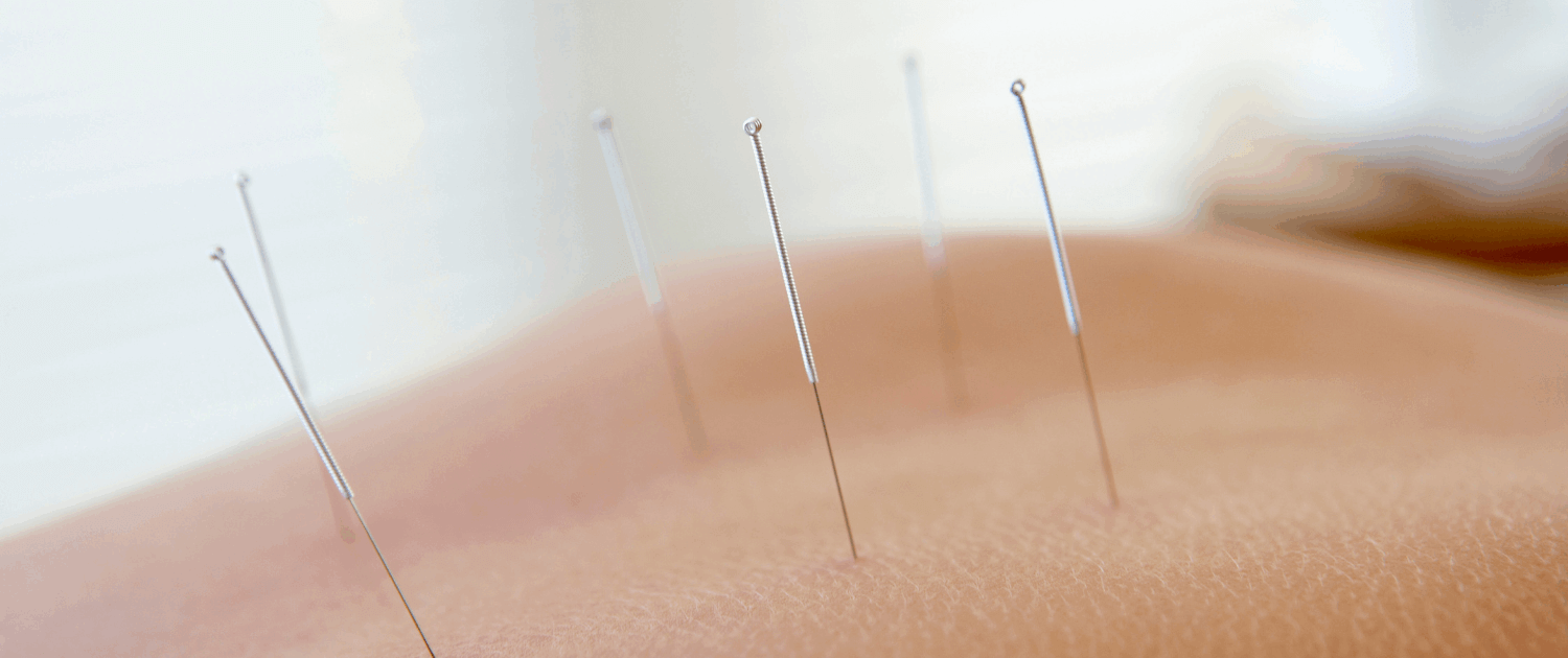 Top 10 Questions about acupuncture in Naperville Dr Wise - top Naperville Acupuncturist answers top 10 acupuncture questions