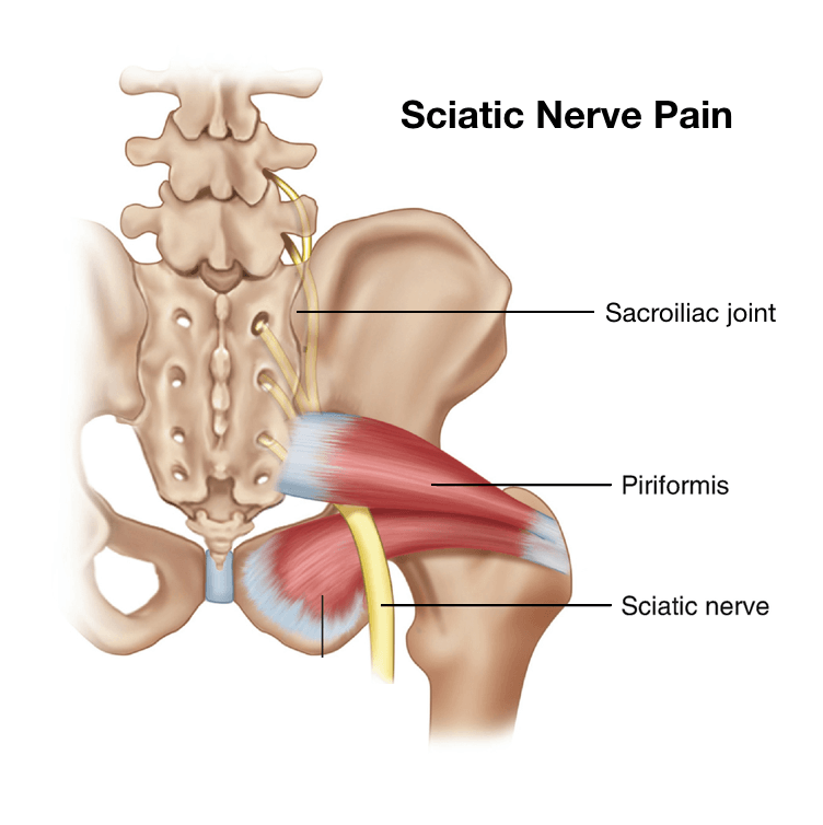 Sciatica Treatment in Naperville