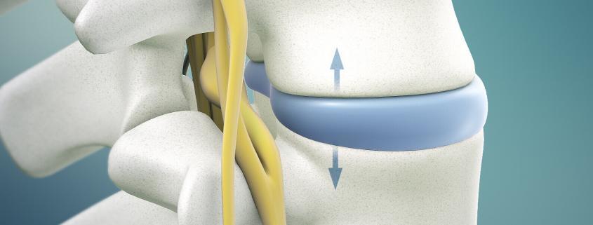 Herniated Disc Treatment in Naperville Herniated Disc Treatment in Naperville