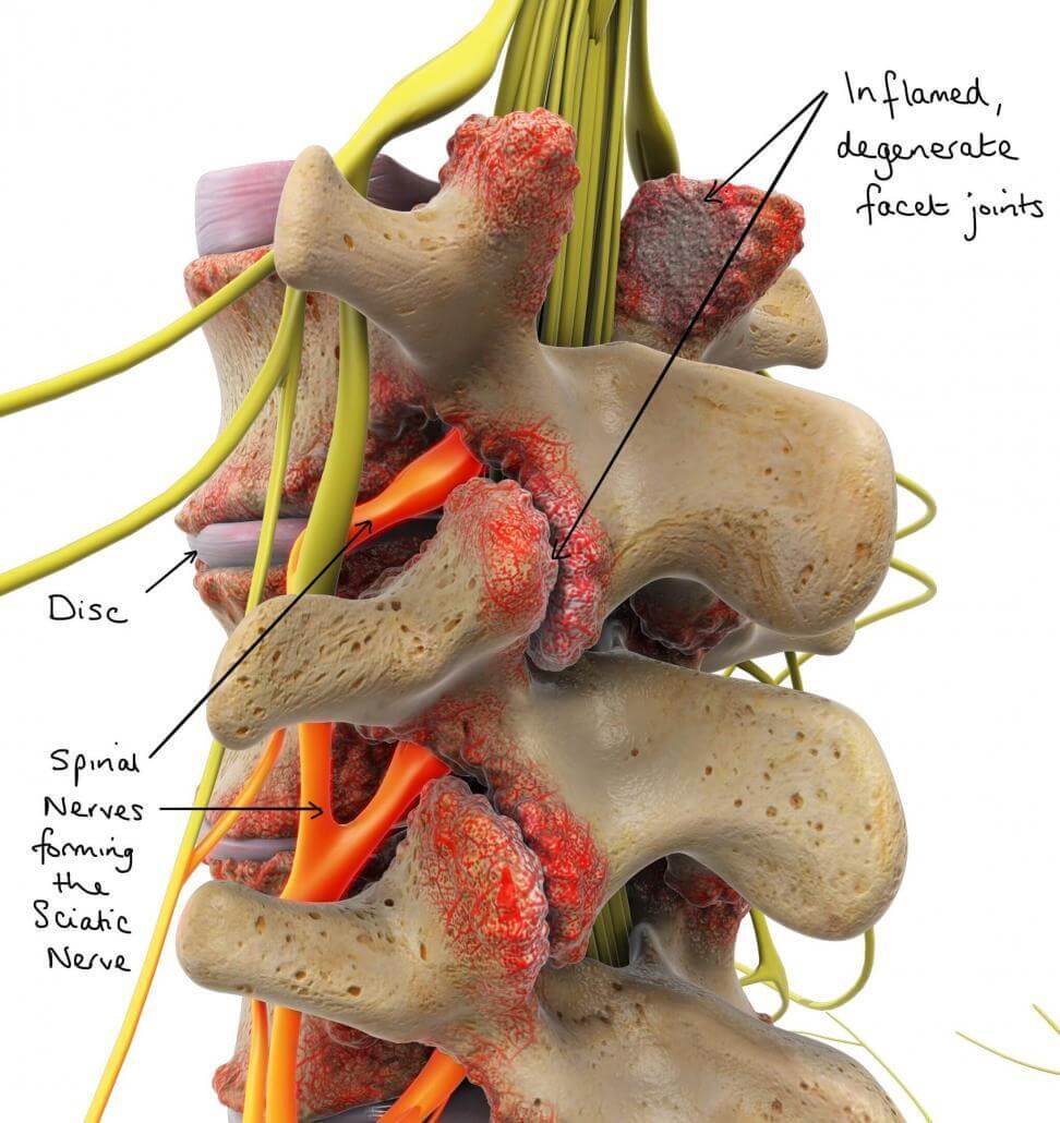 Facet Syndrome Naperville