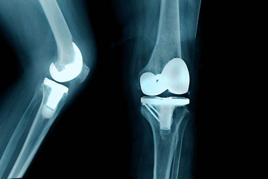 Failed Knee replacement naperville
