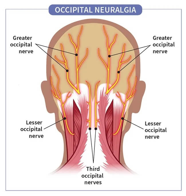 Facet Syndrome Naperville