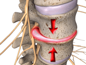 Spinal Decompression for Herniated Discs in Naperville