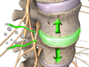 Spinal Decompression for disc problems in naperville