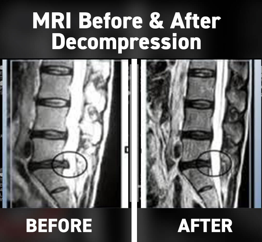 Spinal Decompression for sciatica in naperville