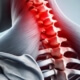 cervical decompression naperville