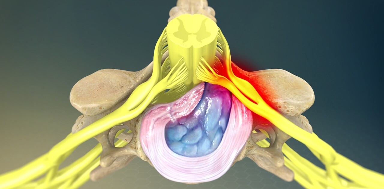 cervical herniated disc treatment in naperville relief from cervical herniated discs in naperville