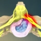 relief from cervical herniated discs in naperville