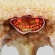 cervical stenosis naperville