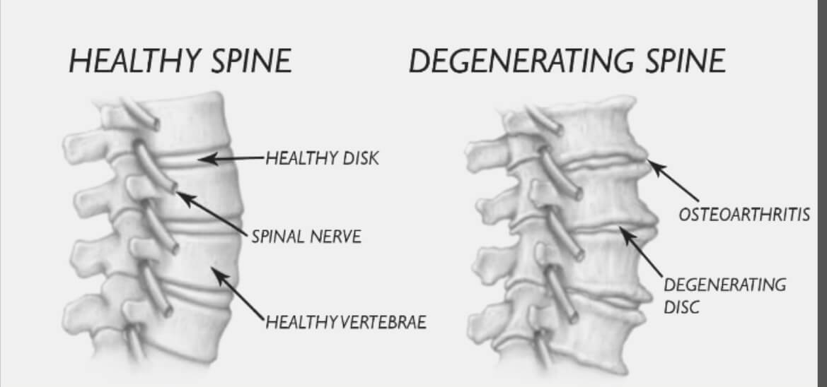 degenerative disc diesease treatments in naperville copy treatments for degenerative disc disease in naperville