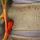 spinal decompression for pinched nerve relief