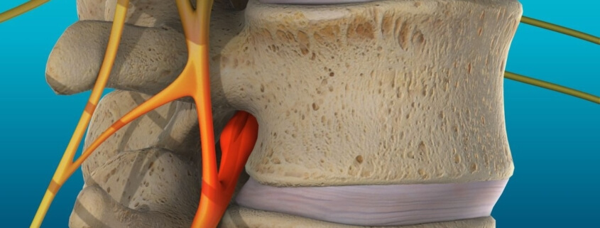 spinal decompression for pinched nerve relief