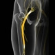 spinal decompression for sciatica in naperville