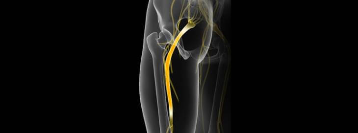 spinal decompression for sciatica in naperville