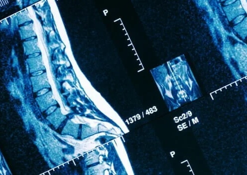 spinal decompression for herniated discs in naperville