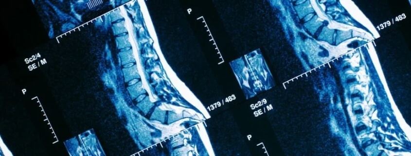 spinal decompression for herniated discs in naperville