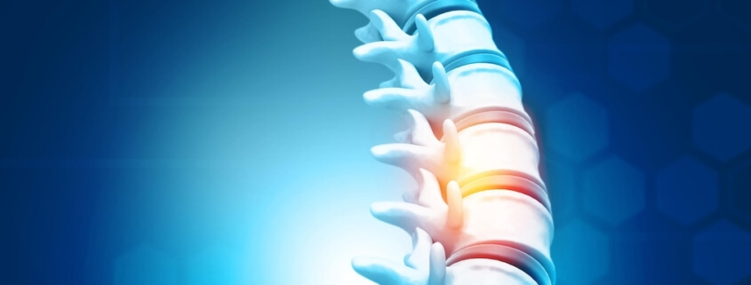 Spinal Decompression in Naperville