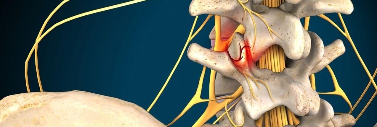 spinal decompresssion for facet syndrome in naperville spinal decompression for facial syndrome in naperville