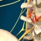 spinal decompression for facial syndrome in naperville