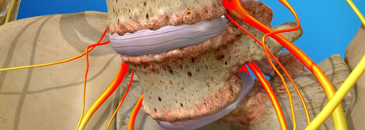 spondylolisthesis-naperville spinal decompression for spondylolisthesis in naperville