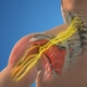 cervical decompression for relief from cervical radicullopathy in naperville