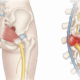 Sciatica vs piriformis syndrome anatomy diagram showing sciatic nerve compression at the spine versus piriformis muscle in the hip — Synergy Institute Acupuncture & Chiropractic Naperville IL