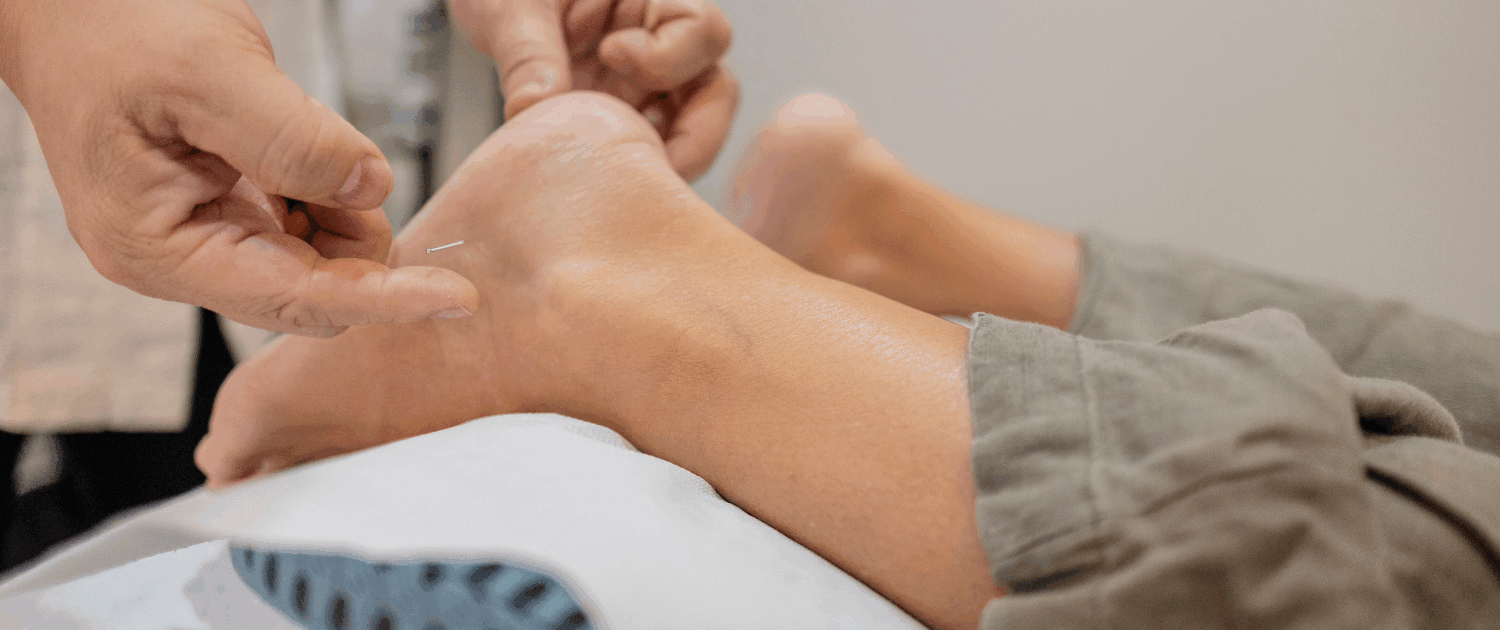 acupuncture for plantar fasciitis relief in Naperville at Synergy Institute Acupuncture & Chiropractic