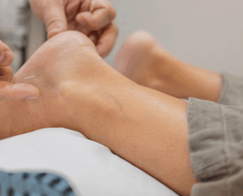 acupuncture for plantar fasciitis relief in Naperville at Synergy Institute Acupuncture & Chiropractic