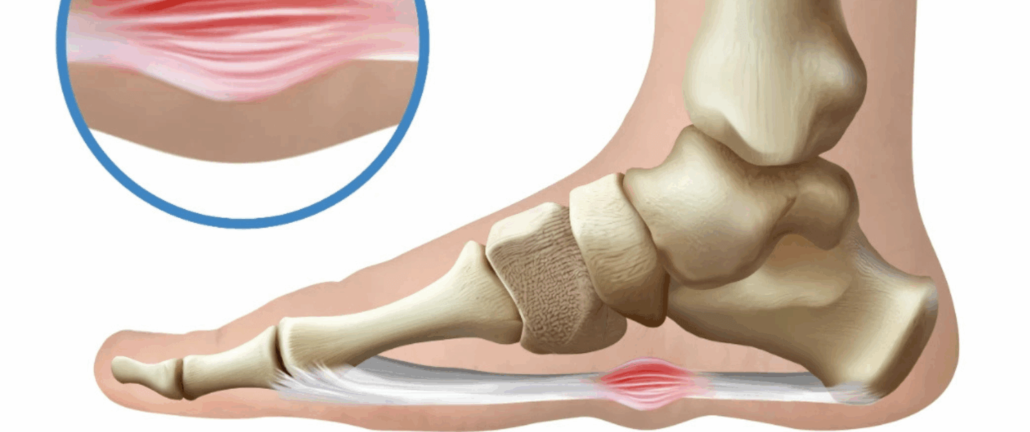 plantar fibromatosis naperville il Plantar fibromatosis treatment in Naperville, IL — Dr. Jennifer Wise combines SoftWave therapy, HT Cellular Reset, and MLS laser to address Ledderhose disease without surgery.