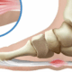 Plantar fibromatosis treatment in Naperville, IL — Dr. Jennifer Wise combines SoftWave therapy, HT Cellular Reset, and MLS laser to address Ledderhose disease without surgery.