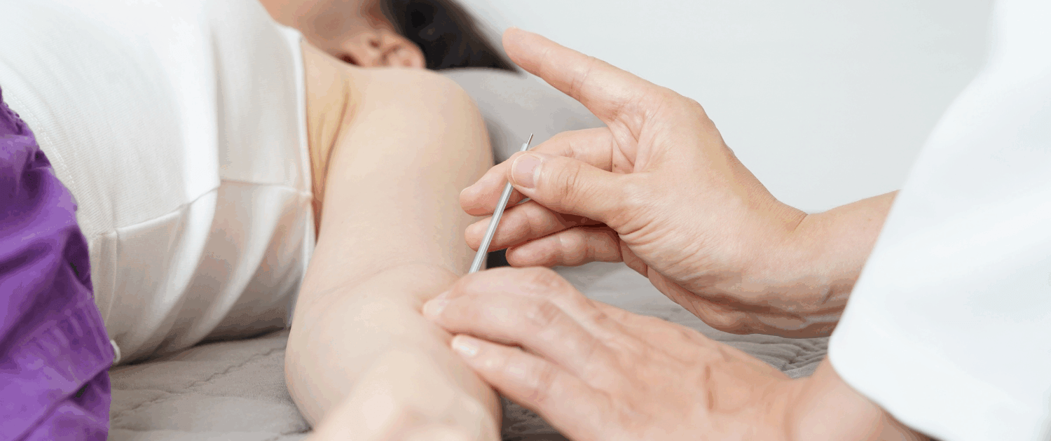 acupuncture for tennis elbow and golfers elbow at Synergy Institute Acupuncture & Chiropractic in Naperville