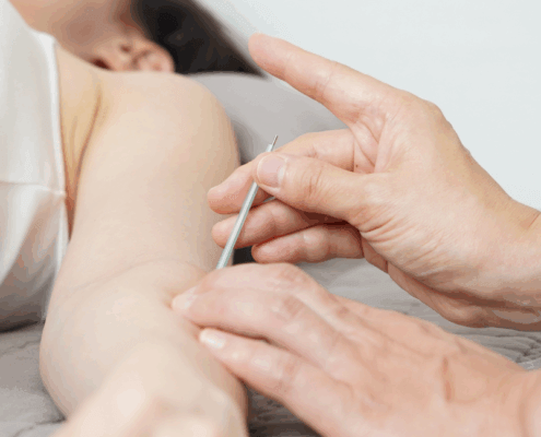 acupuncture for tennis elbow and golfers elbow at Synergy Institute Acupuncture & Chiropractic in Naperville