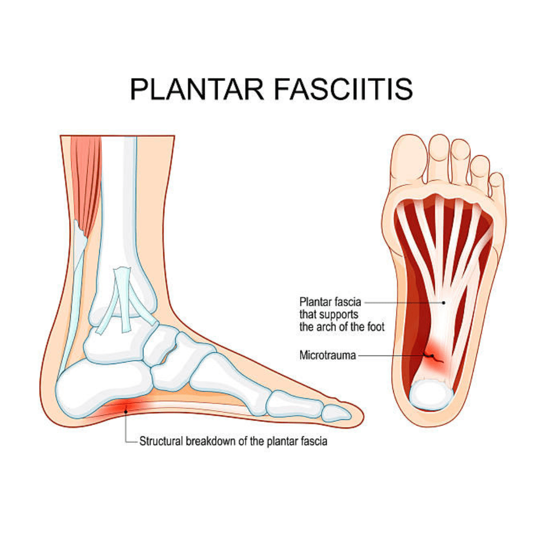 best plantar fasciitis treatments in naperville il