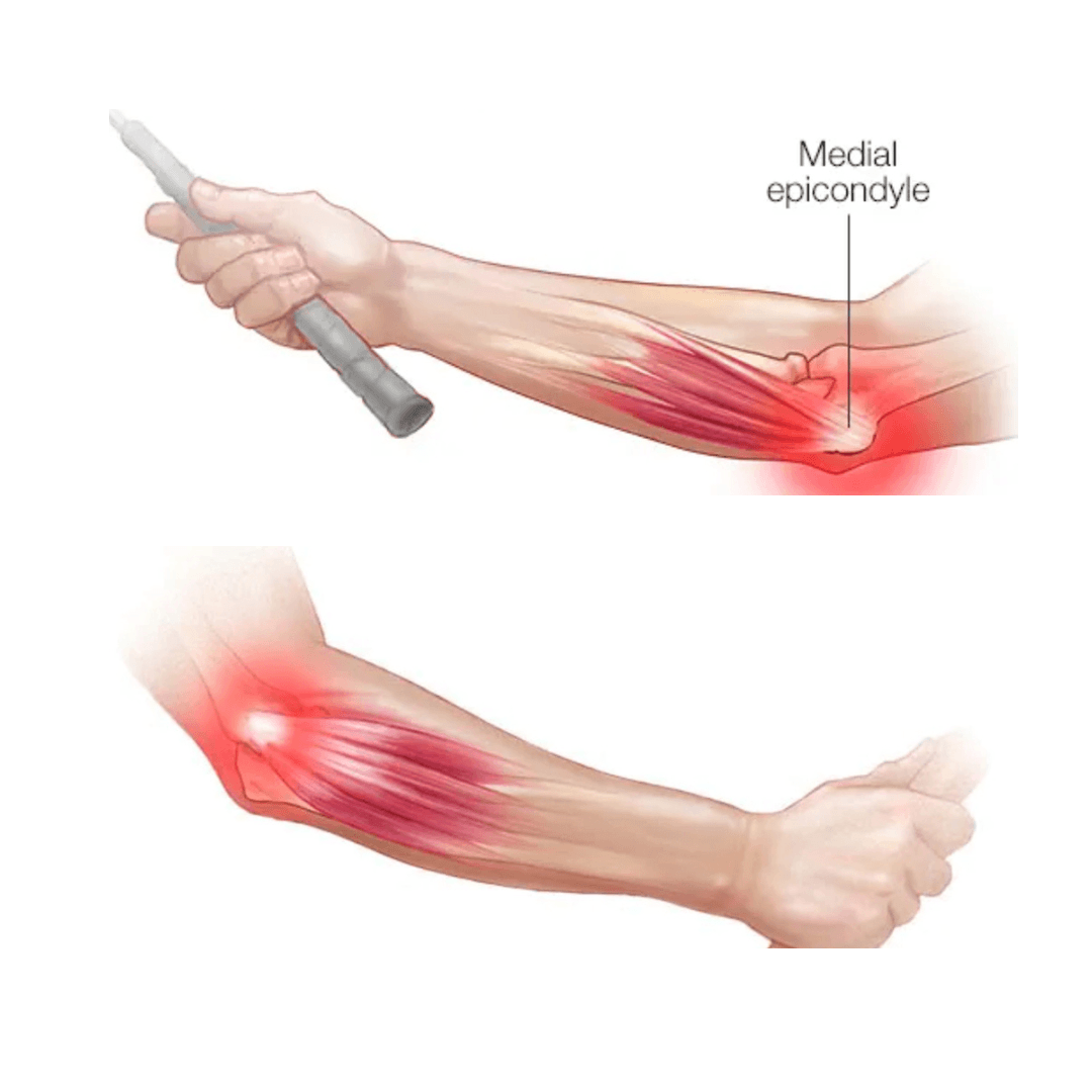 Elbow Pain Treatment Naperville