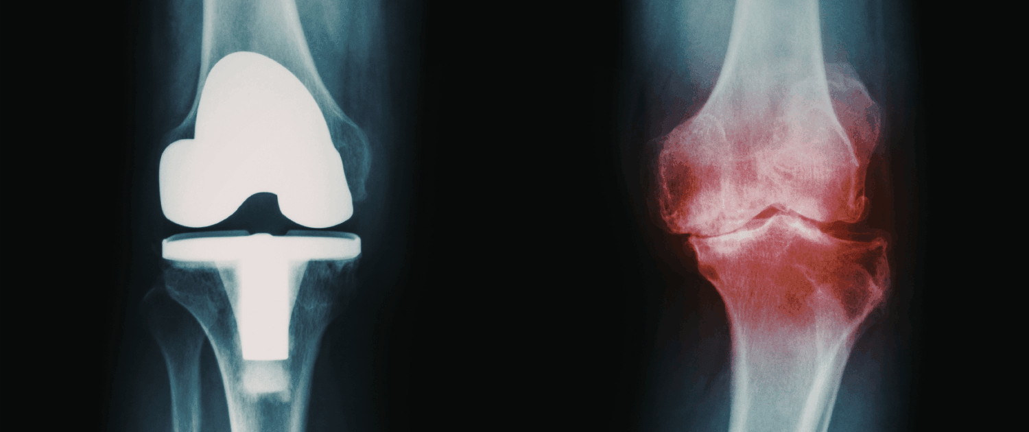 softwave after failed knee replacement in naperville il softwave for failed knee replacement in naperville