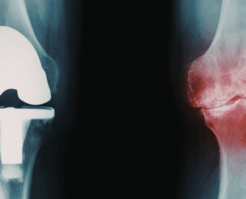 softwave for failed knee replacement in naperville