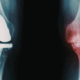 softwave for failed knee replacement in naperville