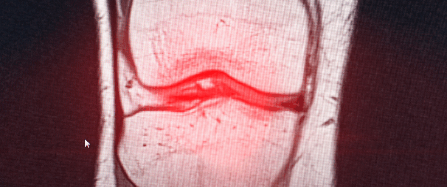 softwave therapy for meniscus injuries in naperville