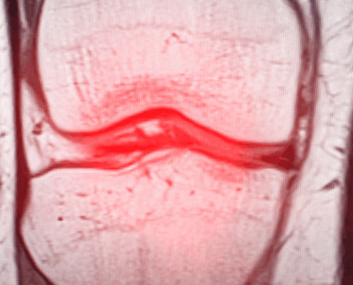 softwave therapy for meniscus injuries in naperville