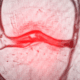 softwave therapy for meniscus injuries in naperville