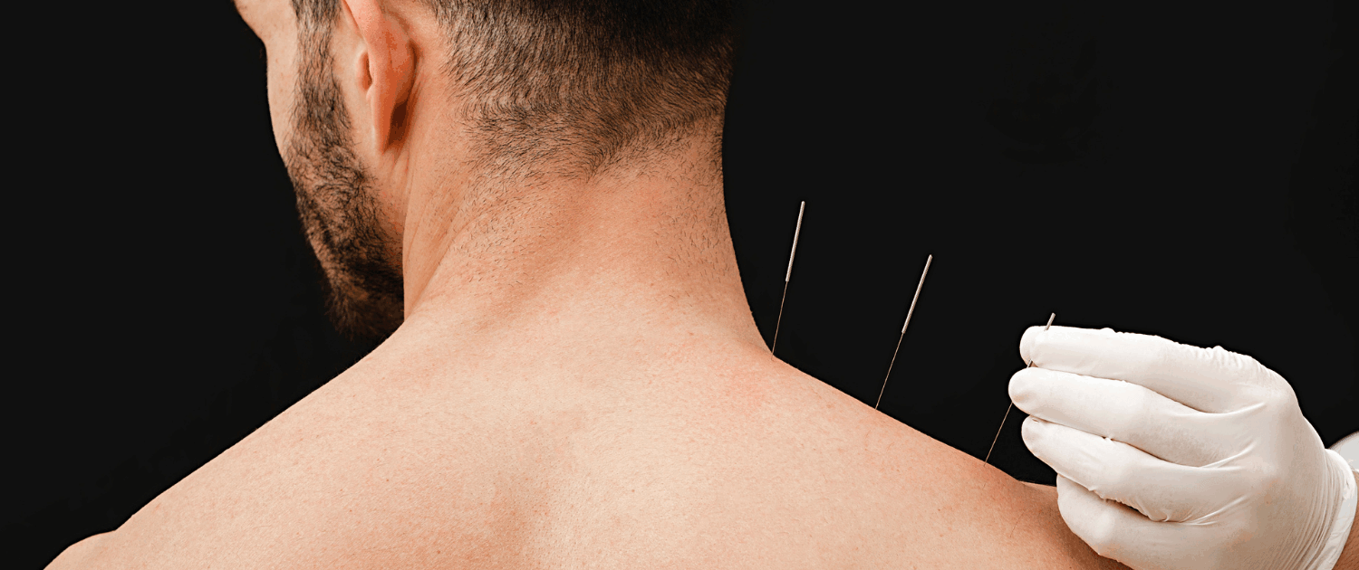 Acupuncture for frozen shoulder in naperville