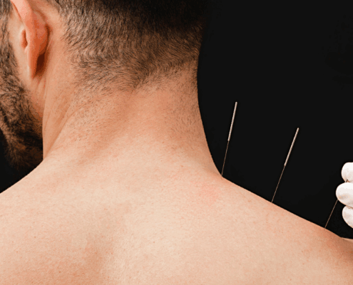 Acupuncture for frozen shoulder in naperville