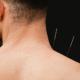 Acupuncture for frozen shoulder in naperville