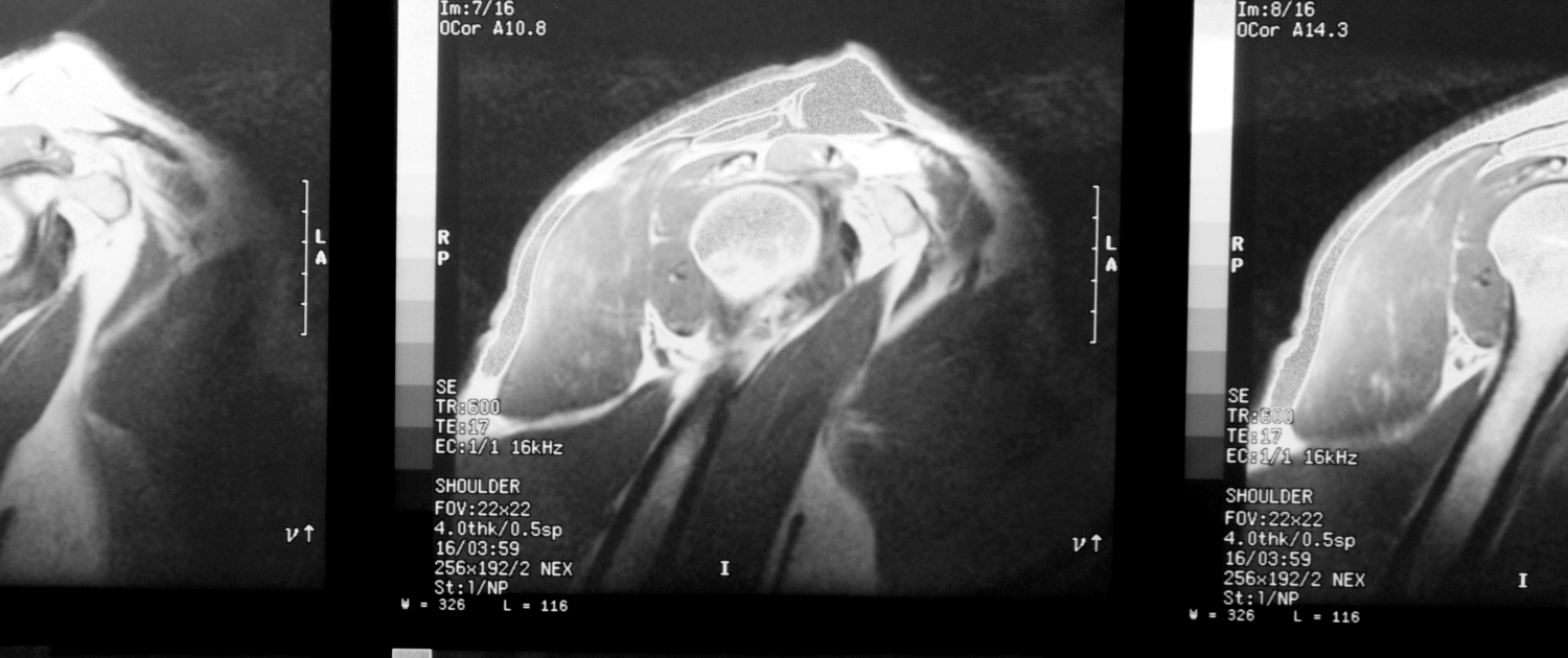 softwave therapy for rotator cuff tears in naperville il non surgical alternatives for rotator cuff tears in naperville il
