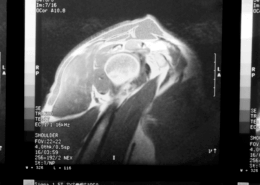 non surgical alternatives for rotator cuff tears in naperville il