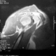 non surgical alternatives for rotator cuff tears in naperville il