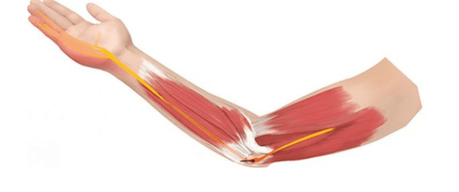get relief from cubital tunnel syndrome on naperville il