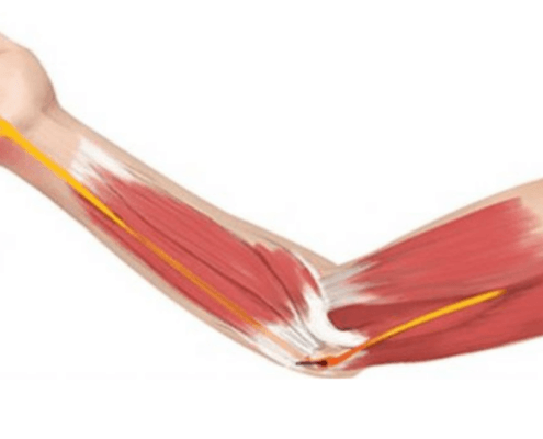 get relief from cubital tunnel syndrome on naperville il