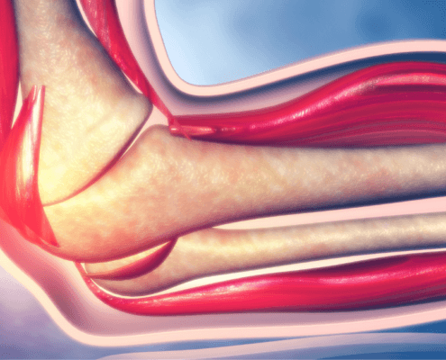 relief from elbow tendonitis in naperville il