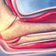 relief from elbow tendonitis in naperville il